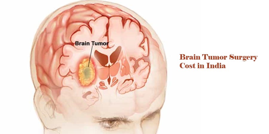 brainTumor Surgery Cost India